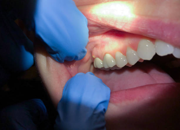 Best Urgent Tooth Repair  in Pine Grove Mills, PA